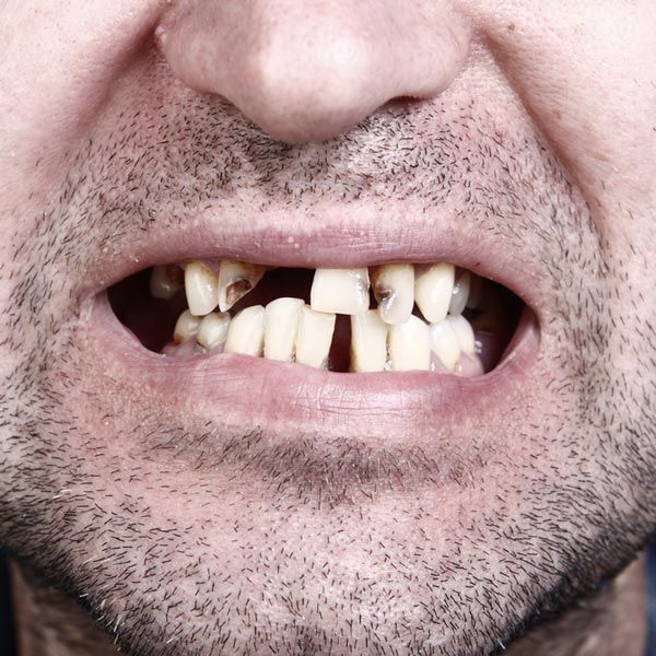 Man's chipped and missing teeth